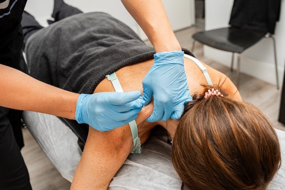 Pilates Canal Madrid Una persona se tumba boca abajo sobre una camilla mientras un terapeuta con guantes azules realiza la acupuntura o punción seca, típica de la fisioterapia en Madrid, introduciendo agujas en el hombro de la persona. El paciente va cubierto con una manta negra y lleva una goma para el pelo.